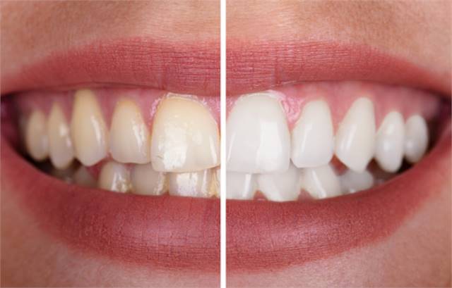 Teeth Whitening Crowley TX - Zoom Whitening Crowley