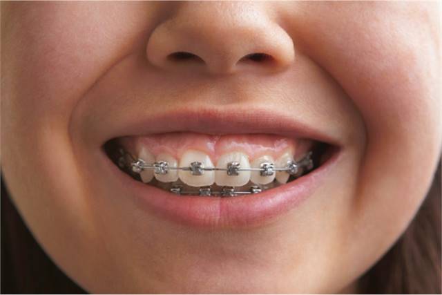 Traditional Braces in Fort Worth